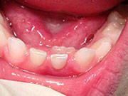 Baby Teeth - Pediatric Dentist in Columbus, OH