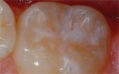Sealant-After - Pediatric Dentist in Columbus, OH